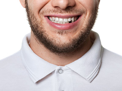 Yu Smile Dental | Dental Fillings, Missing Teeth and Dentures