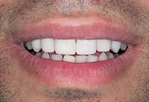 Yu Smile Dental | Implant Dentistry, Missing Teeth and Dental Fillings