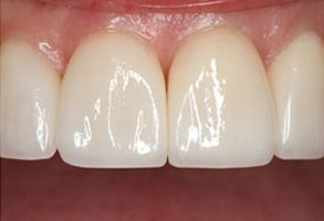 Yu Smile Dental | Veneers, Invisalign reg  and CBCT