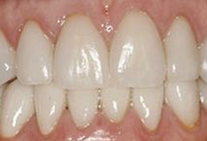 Yu Smile Dental | Tooth Pain or Infection, Inlays  amp  Onlays and Laser Dentistry