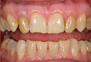 Yu Smile Dental | Missing Teeth, Teeth Whitening and Crooked or Crowded Teeth