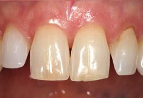 Yu Smile Dental | Veneers, Crowns  amp  Caps and Bad Breath